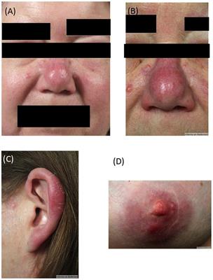 Case report of disseminated borrelial lymphocytoma with isolation of Borrelia burgdorferi sensu stricto in chronic lymphatic leukemia stage Binet A—an 11 year follow up